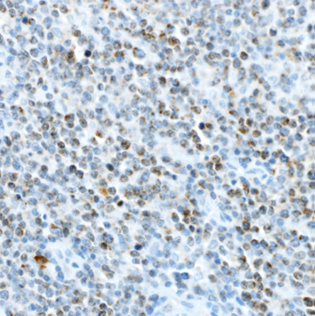 B-cell lymphoma