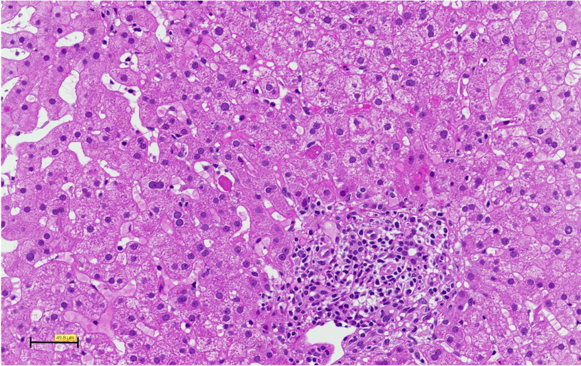 hepatitis_e