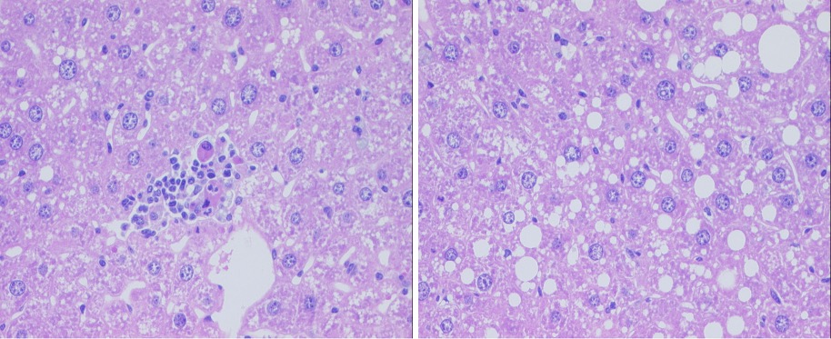 Liver_cancer